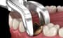 Tooth Extraction