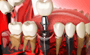 Dental Implant