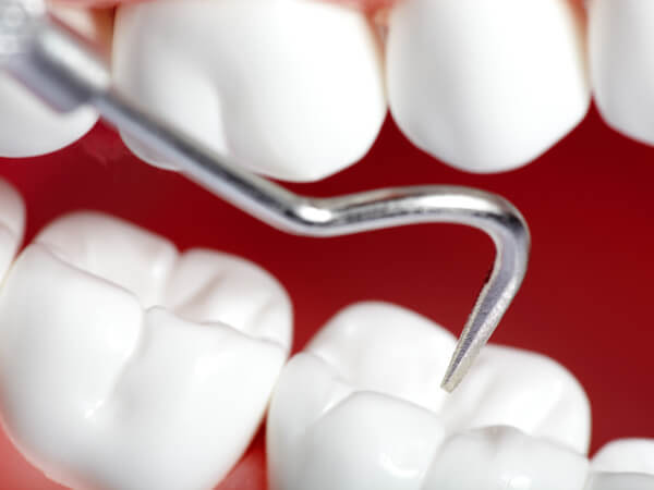 Tooth Bonding