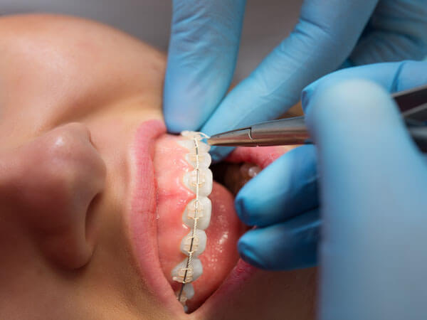 Braces