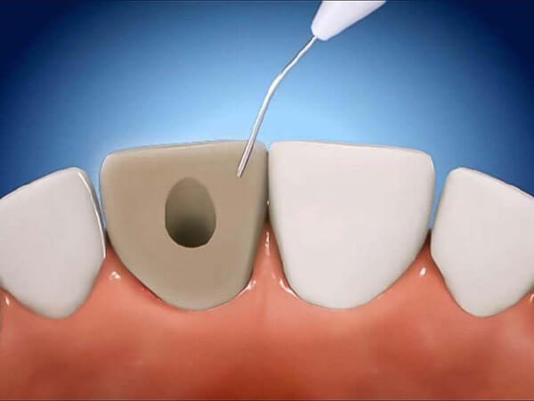internal-bleaching
