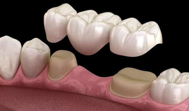 Dental Bridge
