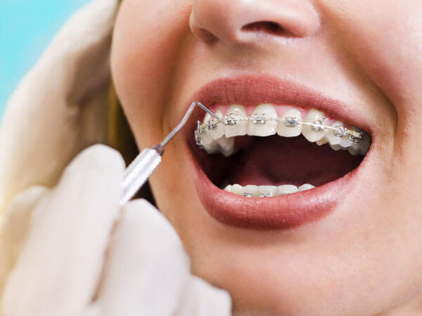 braces-clean