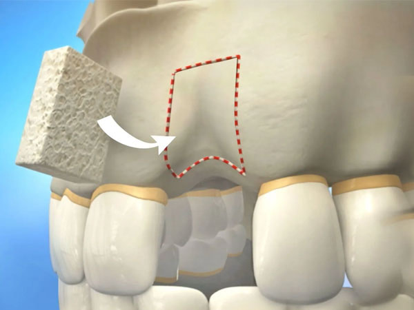 Bone Grafting